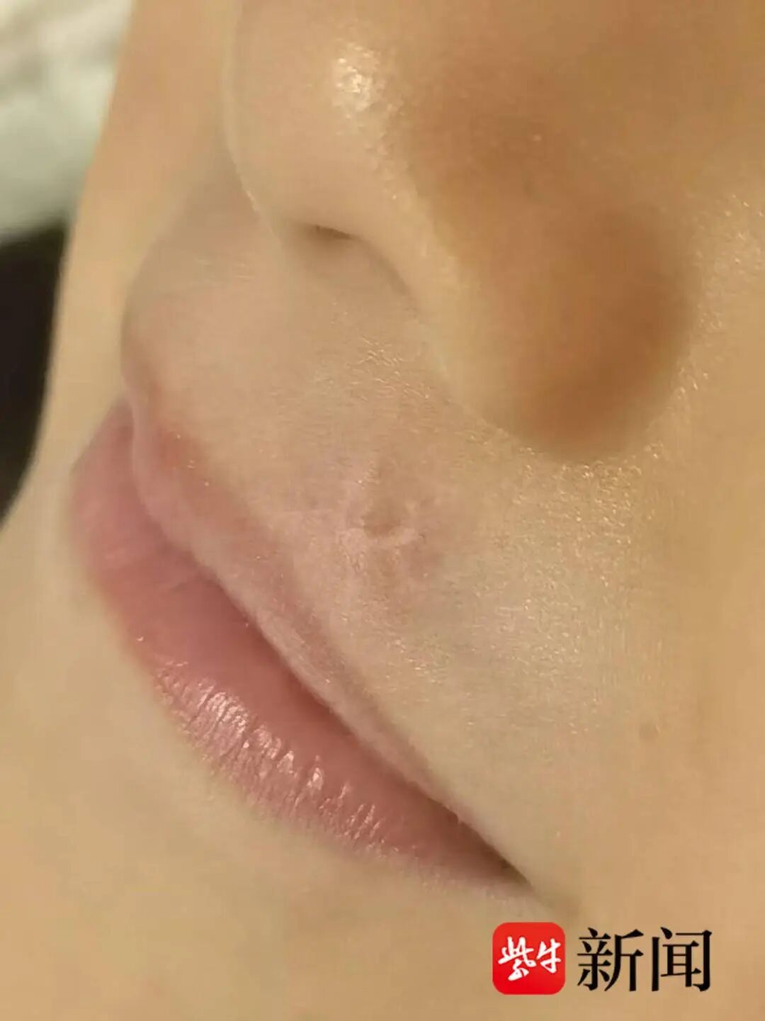 即使经过多次治疗，孩子面部仍留有疤痕